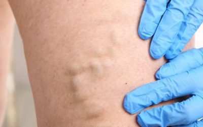 Dodatkom rutina Proven postiže pobolj&scaron;anje stanja pro&scaron;irenih i otečenih vena nogu i hemoroida