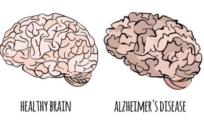 Alfa-lipoinska kiselina u Provenu kao pomoć nakon moždanog udara i kod Alchajmerove bolesti